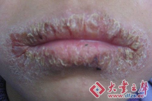 唇炎症状.   来源:资料图片
